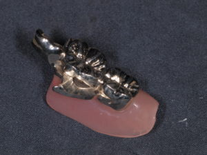 CSPリーゲルテレスコープ義歯/ノナカデンタルクリニック